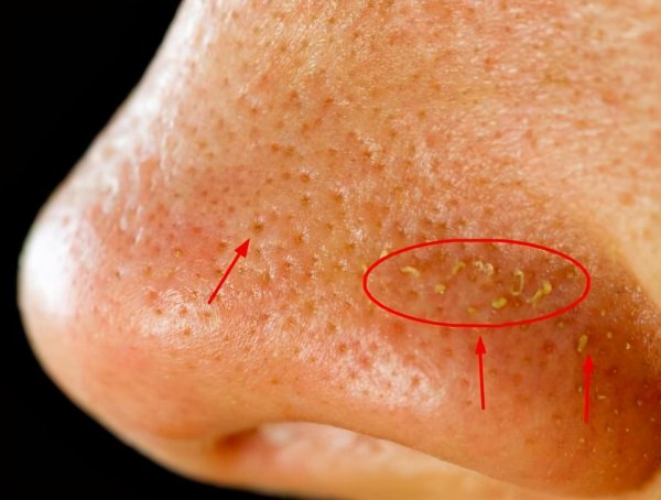 脸上挤出硬粒是螨虫吗