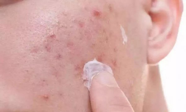 脸上挤出硬粒是螨虫吗