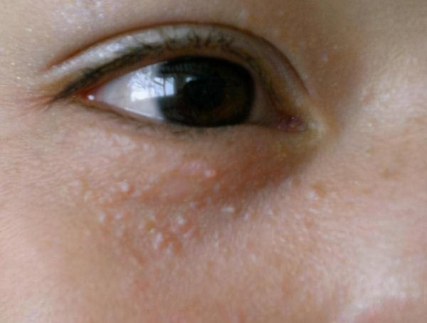 脸上挤出硬粒是螨虫吗