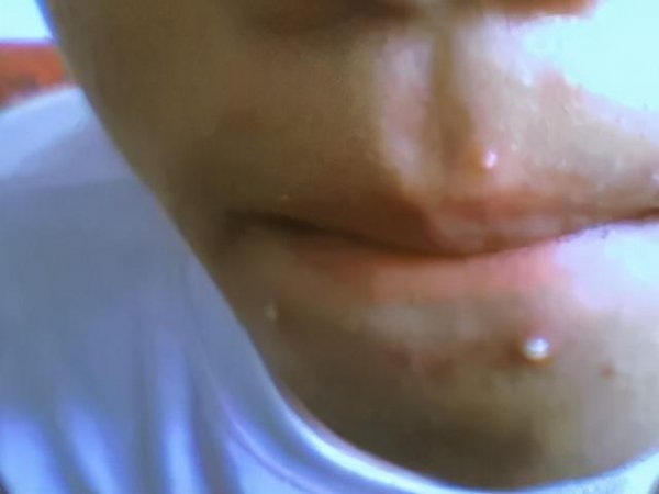 脸上挤出硬粒是螨虫吗