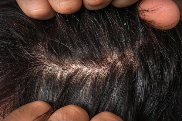 不用洗头膏洗头有什么好处