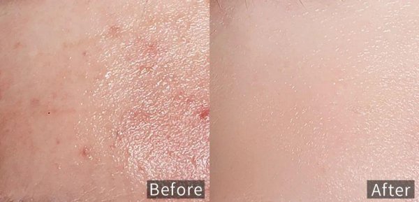 新手刷酸正确的护肤步骤