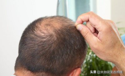 头发软又细又少怎么办 头发细软并且量还少原因及改善方法