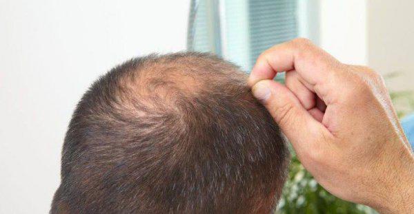 头发软又细又少怎么办