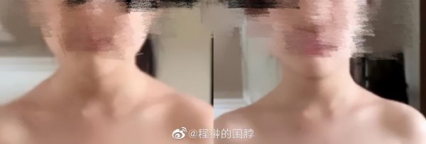 肩膀厚有什么办法改善