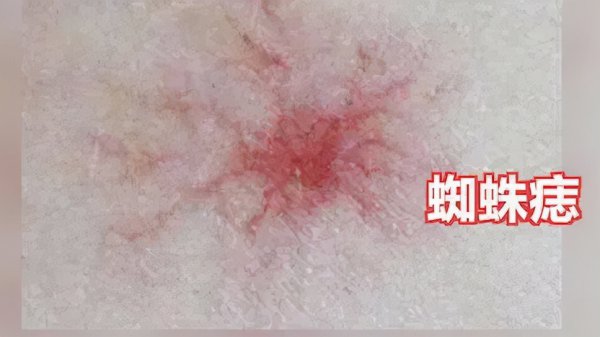 身上有红点是怎么回事