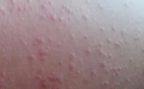 身上有红点是怎么回事