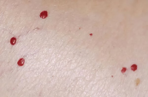 身上有红点是怎么回事