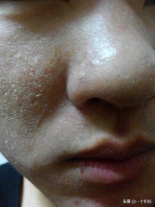 洗完脸后脸上起白皮怎么办 脸上起白皮的原因是什么