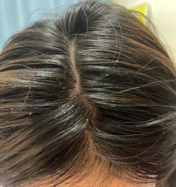 口碑最好的去屑洗发水