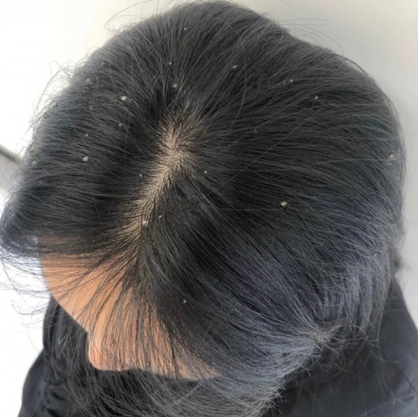 口碑最好的去屑洗发水