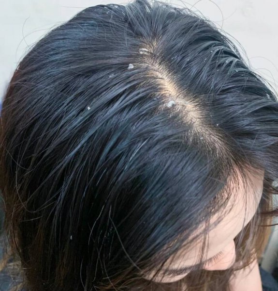 口碑最好的去屑洗发水