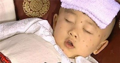 天花什么时候消灭的 天花病毒在哪一年时间被彻底灭绝的