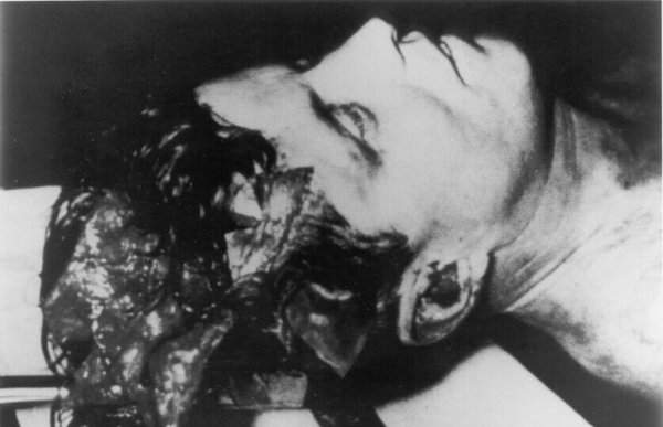 肯尼迪头盖骨事件