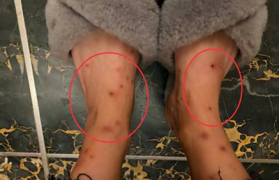 跳蚤的寿命有多长能活多久 如果被跳蚤咬了该怎么办