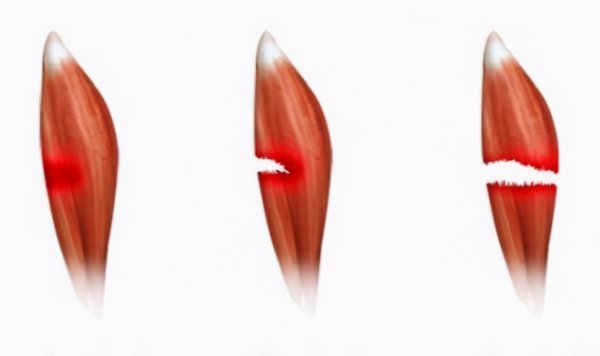 肌肉拉伤热敷还是冷敷