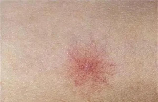 身上长红点是什么原因
