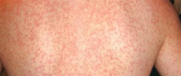 身上长红点是什么原因