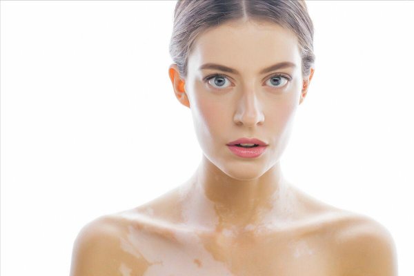 身上出现白色斑块是什么原因