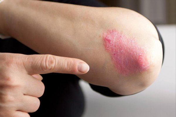 身上出现白色斑块是什么原因