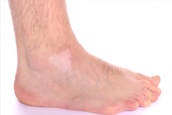 身上出现白色斑块是什么原因