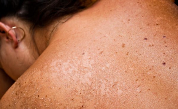 晒了一天太阳皮肤晒黑怎么修复