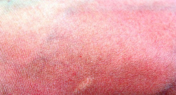 晒了一天太阳皮肤晒黑怎么修复