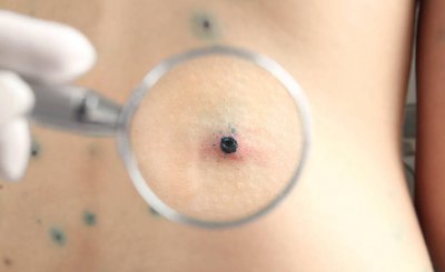 脚底有痣好吗代表了什么 脚底有痣有什么寓意可能患病吗