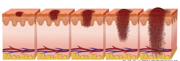 脚底有痣好吗代表了什么