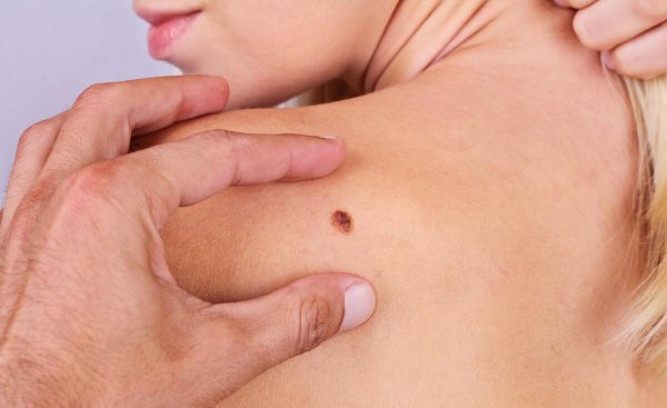 脚底有痣好吗代表了什么