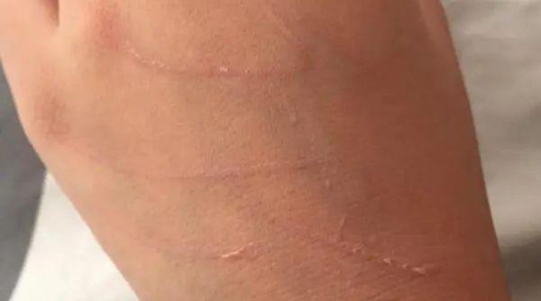 被猫抓了一下轻微破皮要打针吗