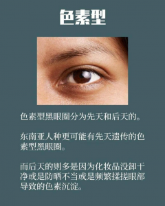 熊猫眼怎么消除小方法 如何快速消除熊猫眼的小窍门
