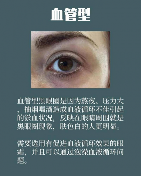 熊猫眼怎么消除小方法