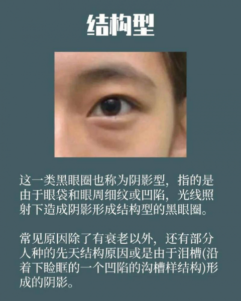 熊猫眼怎么消除小方法