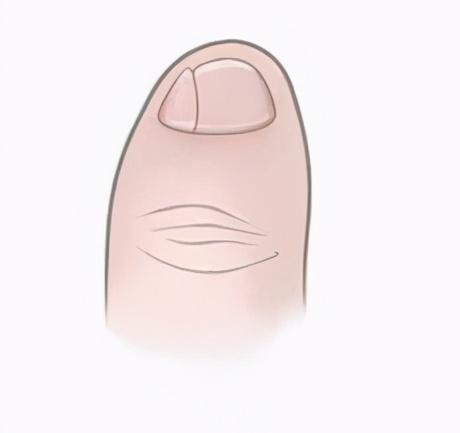 小脚趾有两瓣指甲是什么族