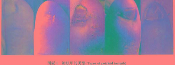 小脚趾甲两瓣是哪族人