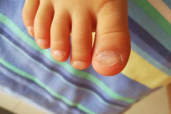 小脚趾甲两瓣是哪族人