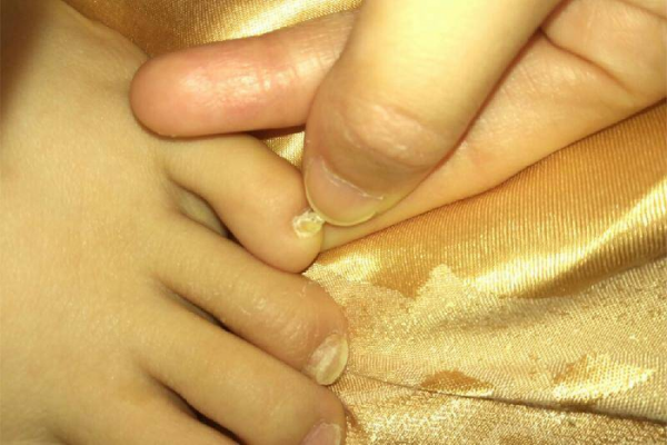 小脚趾甲两瓣是哪族人