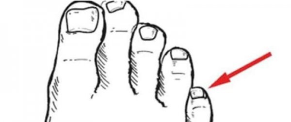 小脚趾甲两瓣是哪族人