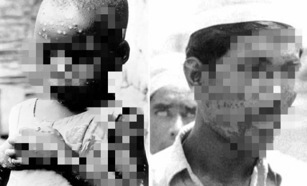 牛痘疫苗是谁发明的