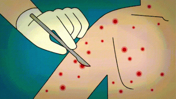 牛痘疫苗是谁发明的