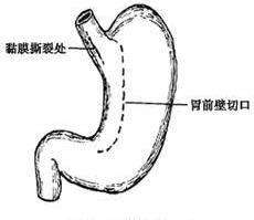 催吐是什么意思
