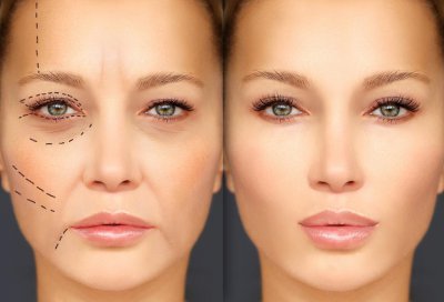 为什么20岁就有法令纹了 法令纹的形成原因及改善方法