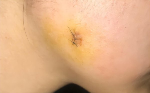 什么牌子的祛疤膏效果好