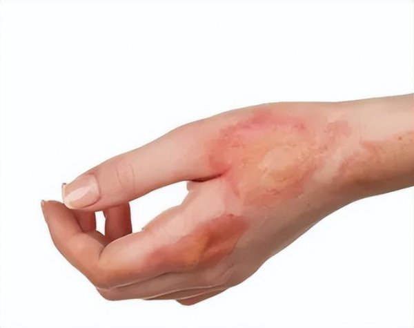 什么牌子的祛疤膏效果好