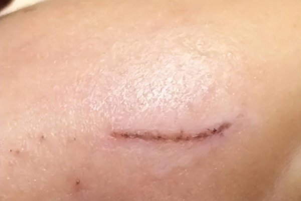 什么牌子的祛疤膏效果好