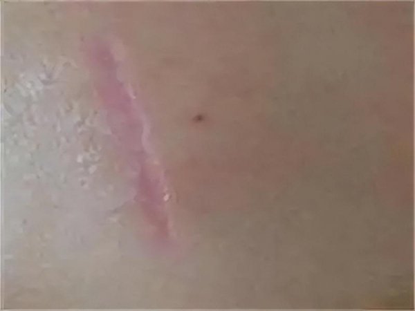 什么牌子的祛疤膏效果好