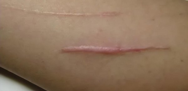 什么牌子的祛疤膏效果好