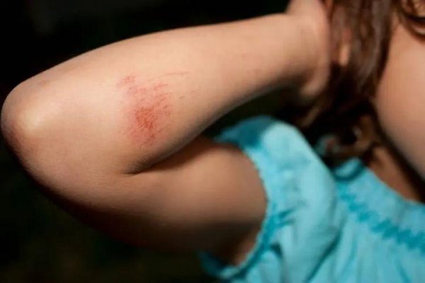 什么牌子的祛疤膏效果好