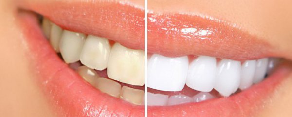 牙齿礼仪有哪些注意事项